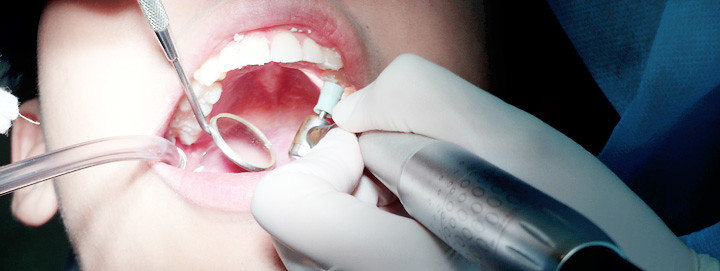 teeth cleaning at omni dental centre