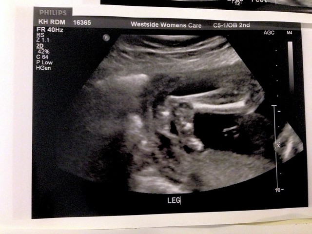 21 week ultrasound for second boy