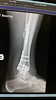 22-01-2015 x-ray of right leg from right hand side