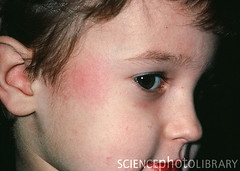 This disease is characterized by maculopapular blotches that run together, A low grade fever and malaise and a "slapped-cheek appearance.