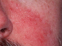 a redness associated with a variety of skin lashes