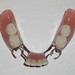Removable Partial Denture