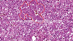 Results from hypoxic or anoxic injury due to ischemia (infarct); persistence of dead cells with intact outlines but has loss of cellular details particulary nuclei; OCCURS IN ALL SOLID ORGANS (except for the brain); denautes both cellular proteins...