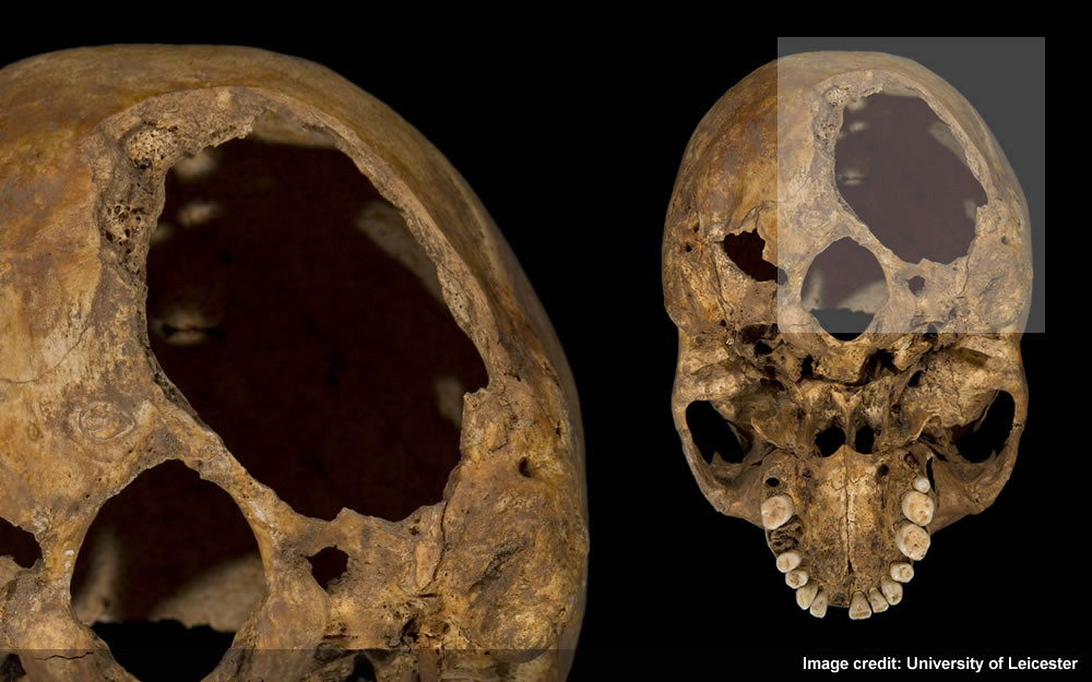 Injury 1 - Large hole underneath back of skull