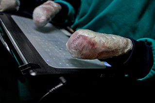 Nixa types on a laptop. She and her sister wrap their entire bodies in plastic to protect their skin from further damage.
