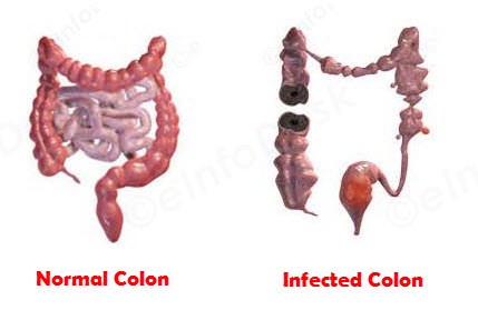 colon status in constipation