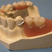 Removable Partial Denture