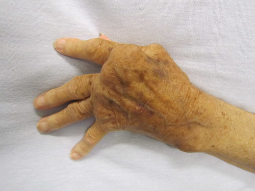 Rheumatoid Arthritis by MyArthritis, on Flickr