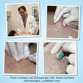Joel Schlessinger MD explains how to remove troublesome moles