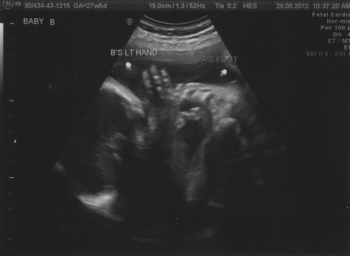 Week 28 ultrasound