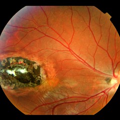 immunocompromised pt w/ sever necrotizing retinochoroiditis w/ necrosis in retina, white fluffy lesions around retinal edema, usually w/ ENCEPHALITIS