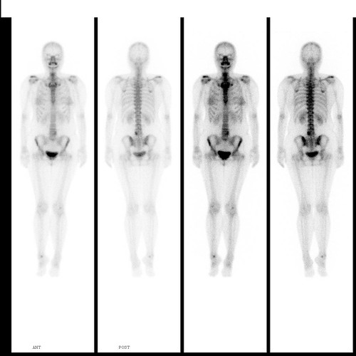 Can someone help me with this bone scan? - Spondylitis Association of ...