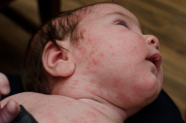 How Long After Amoxicillin Can A Baby Develop A Rash