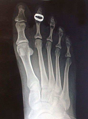 that this see toe with lets many tag pic ring views xray how gets footfetish