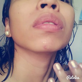 belo-acne-pro-2