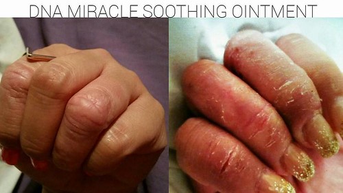  before and after results of hands using DNA Miracles Soothing Ointment