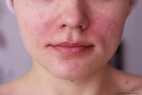 Як лікувати почервоніння на обличчі