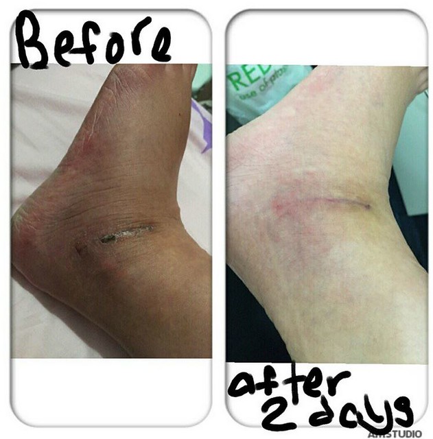  Before and after results of Pentaxyl - foot